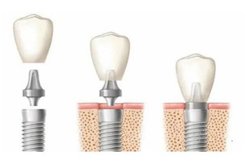 种植牙过程示意图13