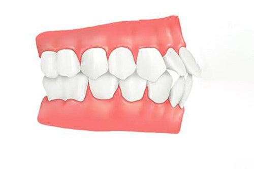 假凸嘴和真凸嘴有哪些不同？形成原因／症状表现／改善方案／诊疗价格均不同！(图1)