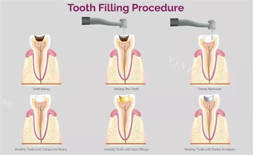 金沙县人民医院口腔科2025价格表一览：种植牙3000元起、牙齿矫正12000元起、补牙220元起(图4)