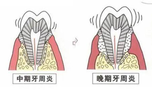 牙周炎症展示图照片