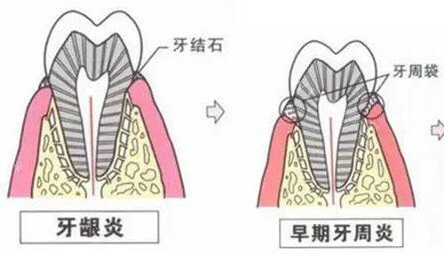 牙周炎过程展示图