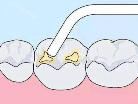 儿童口腔涂氟