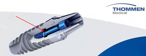 韩国奥齿泰和瑞士ITI种植体哪个好？从它们的材料、技术、价格等方面来看！(图2)