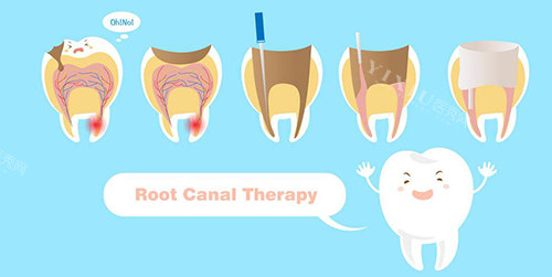 根管治疗详细过程图