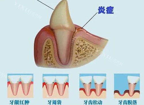 根管治疗改善图展示