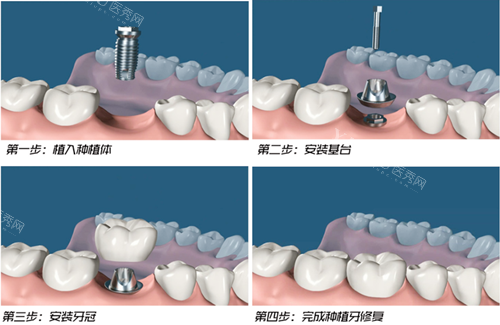 种植牙过程图示