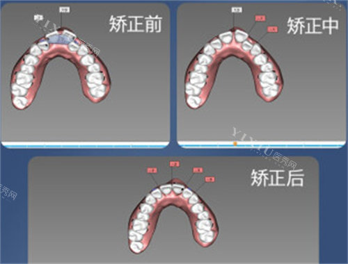 牙齿矫正设计图