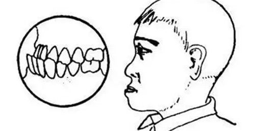 反颌矫正器多少钱？上颌反颌能矫正吗内附佩戴方法详解！
