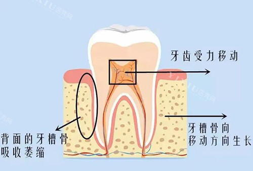 牙齿牙槽骨改善照片