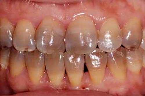 建德2025年看牙收费价格表公开，种植牙2500+正畸6000+洗牙70+点击了解！(图5)