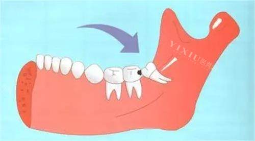 智齿的位置