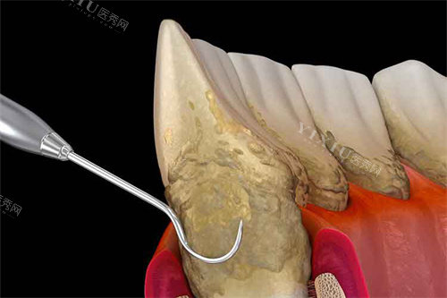 龈下刮治放大