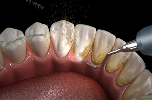 洗牙清洁牙齿结石