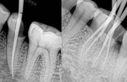 根管治疗ct照片