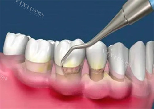 龈下刮治术怎么做