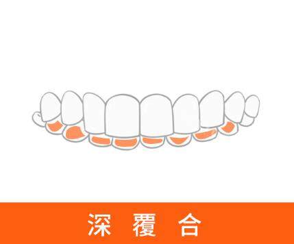 牙齿深覆合展示图