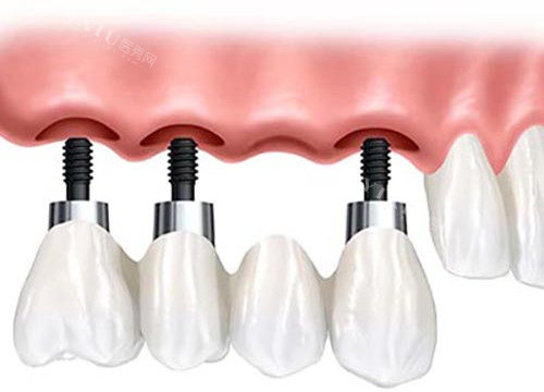 种植牙固定桥修复体