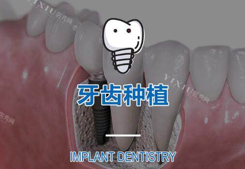 牙齿种植牙卡通图