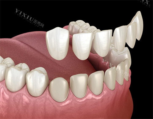 牙齿贴面改善牙齿颜色和形状