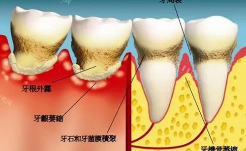 牙周病卡通图展示