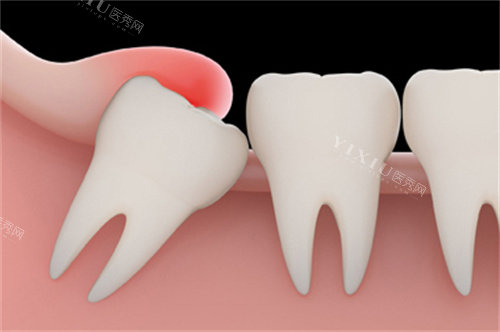 智齿萌出牙龈红肿