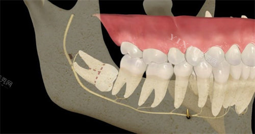 埋伏牙阻生牙示意图