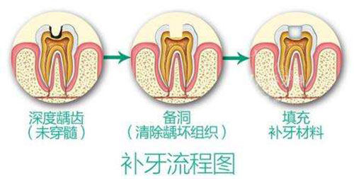 补牙流程图示意图