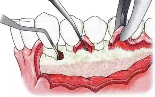 牙周炎翻瓣手术全过程