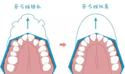 牙弓线错乱展示图