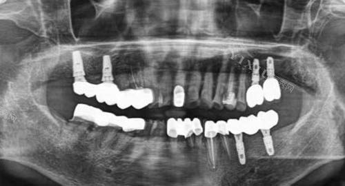 多颗牙齿种植ct