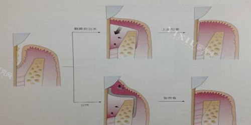牙周炎改善图展示