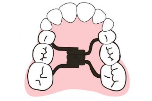 正畸扩弓卡通图