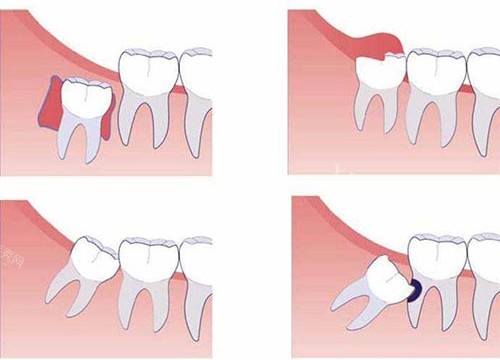 智齿不同部位示意图