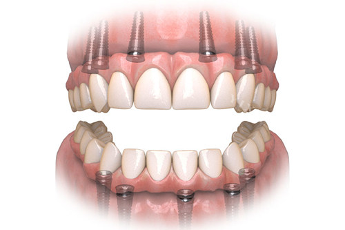 all-on-6全口种植牙示意图
