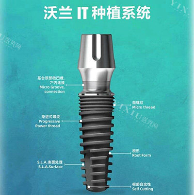 韩国沃兰采用4级纯钛材质、有优异的生物相容性、耐腐蚀、性价比高！(图1)