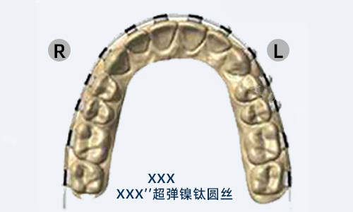 欧欧球托弓丝展示
