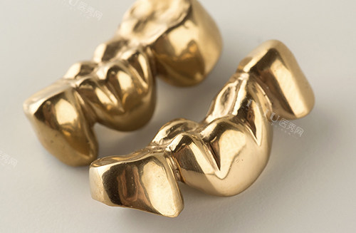 金属冠