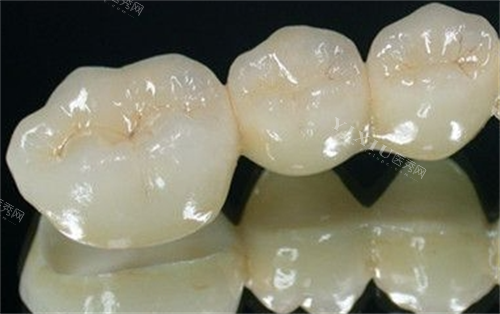 全瓷牙模型展示