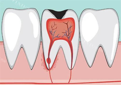 牙髓炎卡通示意图