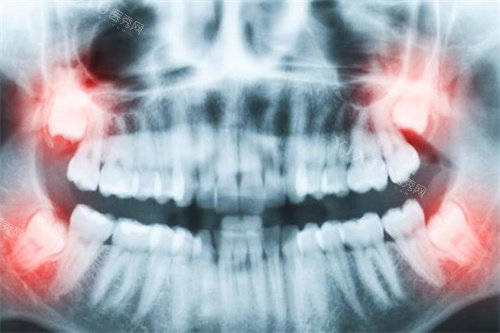 牙齿拍片图