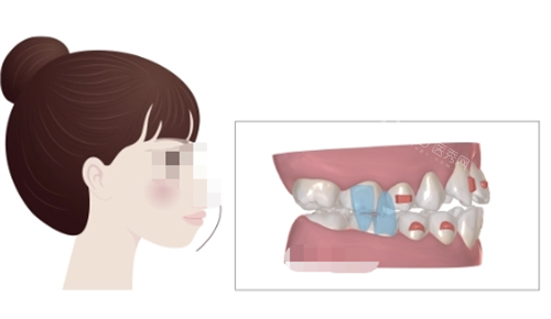 正雅隐形矫正S8突面矫正展示