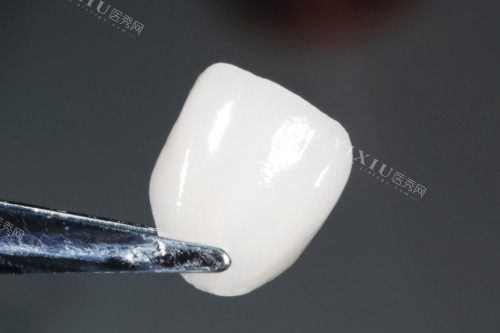 牙贴面材料展示图