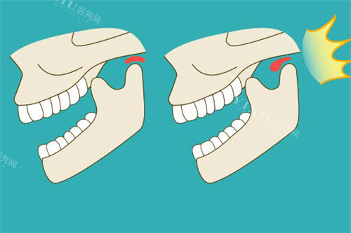 颞下颌关节紊乱疼痛