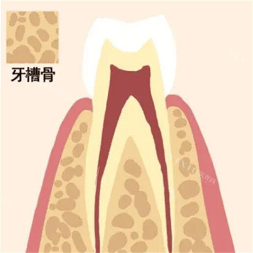 牙槽骨缺失卡通图