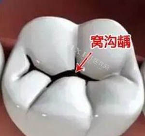 乳牙窝沟封闭