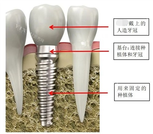 种植牙结构讲解漫画图