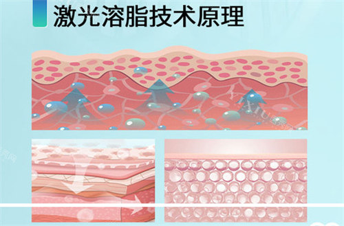 激光溶脂原理
