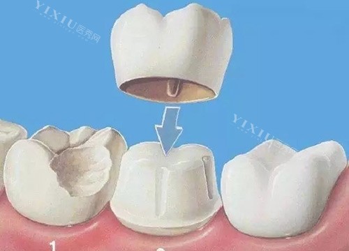 牙冠动画展示图