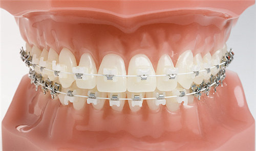 Ceramic-Braces-1