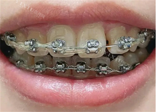 钢丝牙套一般要戴多久？通常需要1-3年左右，但佩戴时长因人而异！(图4)